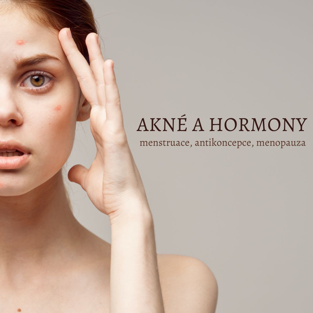 Akné a hormony