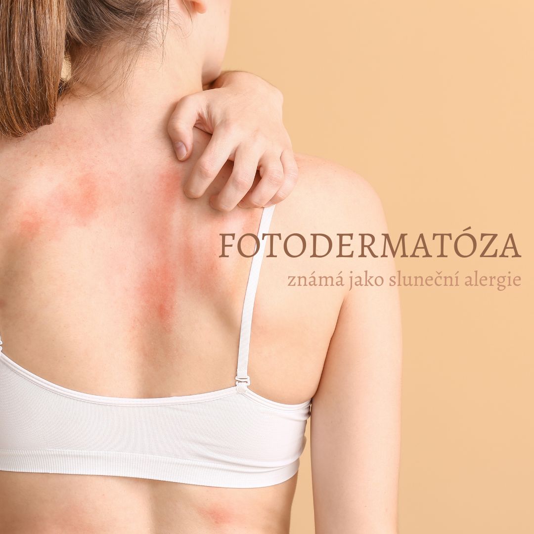 Fotodermatóza neboli "sluneční alergie"