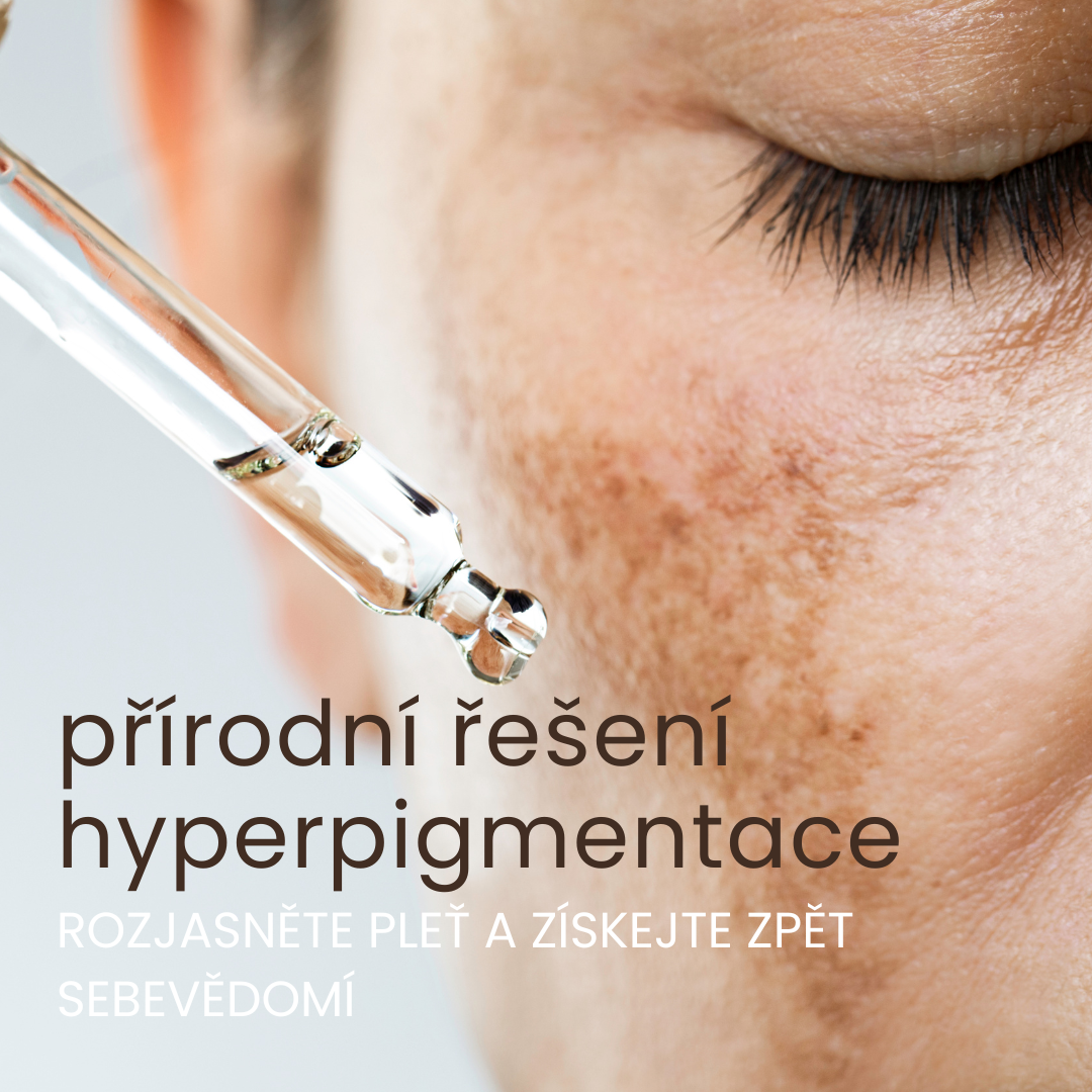 Hyperpigmentace: Proč vzniká a jak ji konečně řešit přírodní cestou