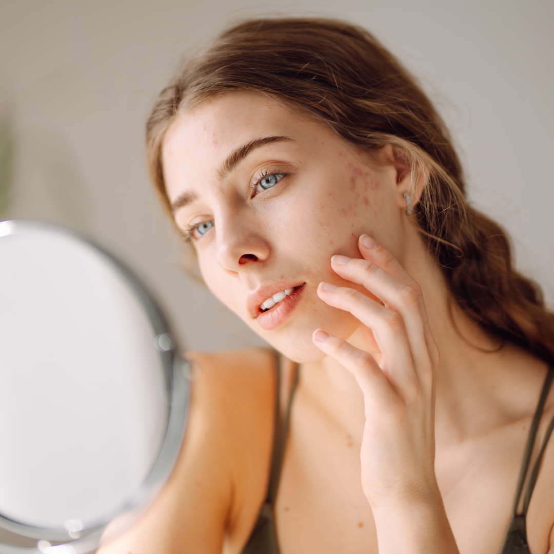 Jak řešit jizvy po akné? Pravidelnost péče je základ