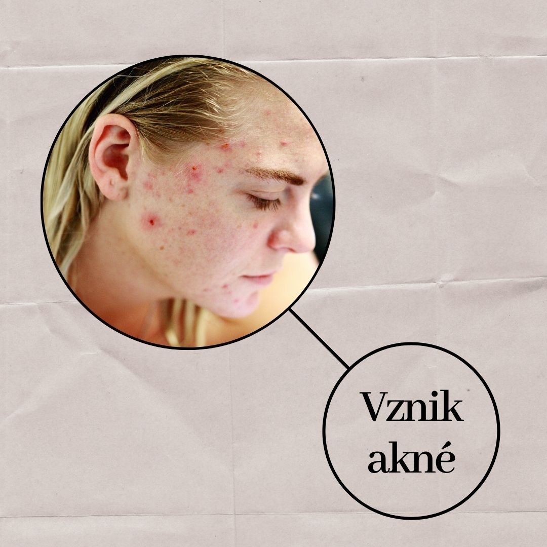Jak vzniká akné? Uvnitř póru