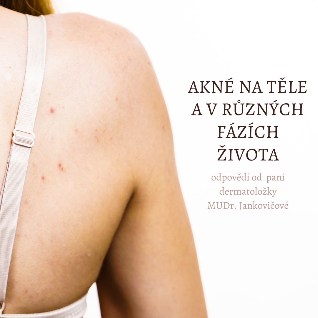 Akné na těle a v různých fázích života. Co s tím?