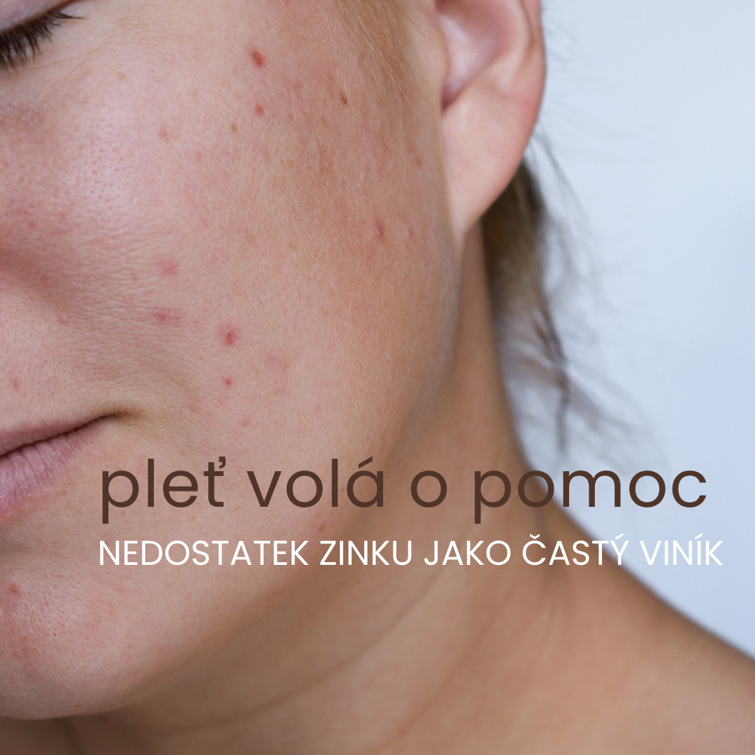 Nedostatek zinku může zhoršit akné až o 60 %. Týká se to i vás?