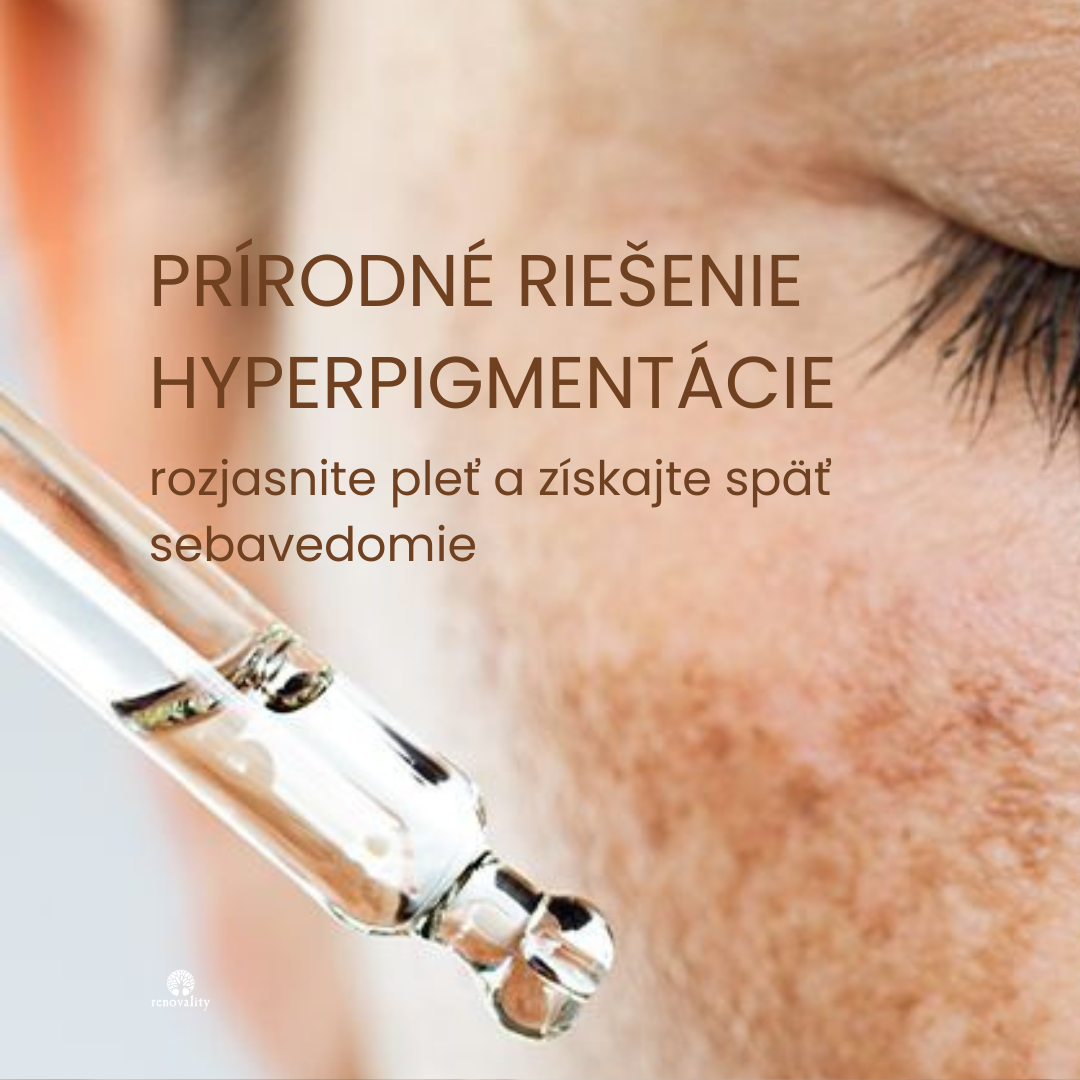 Hyperpigmentácia: prečo vzniká a ako ju konečne vyriešiť prírodným spôsobom