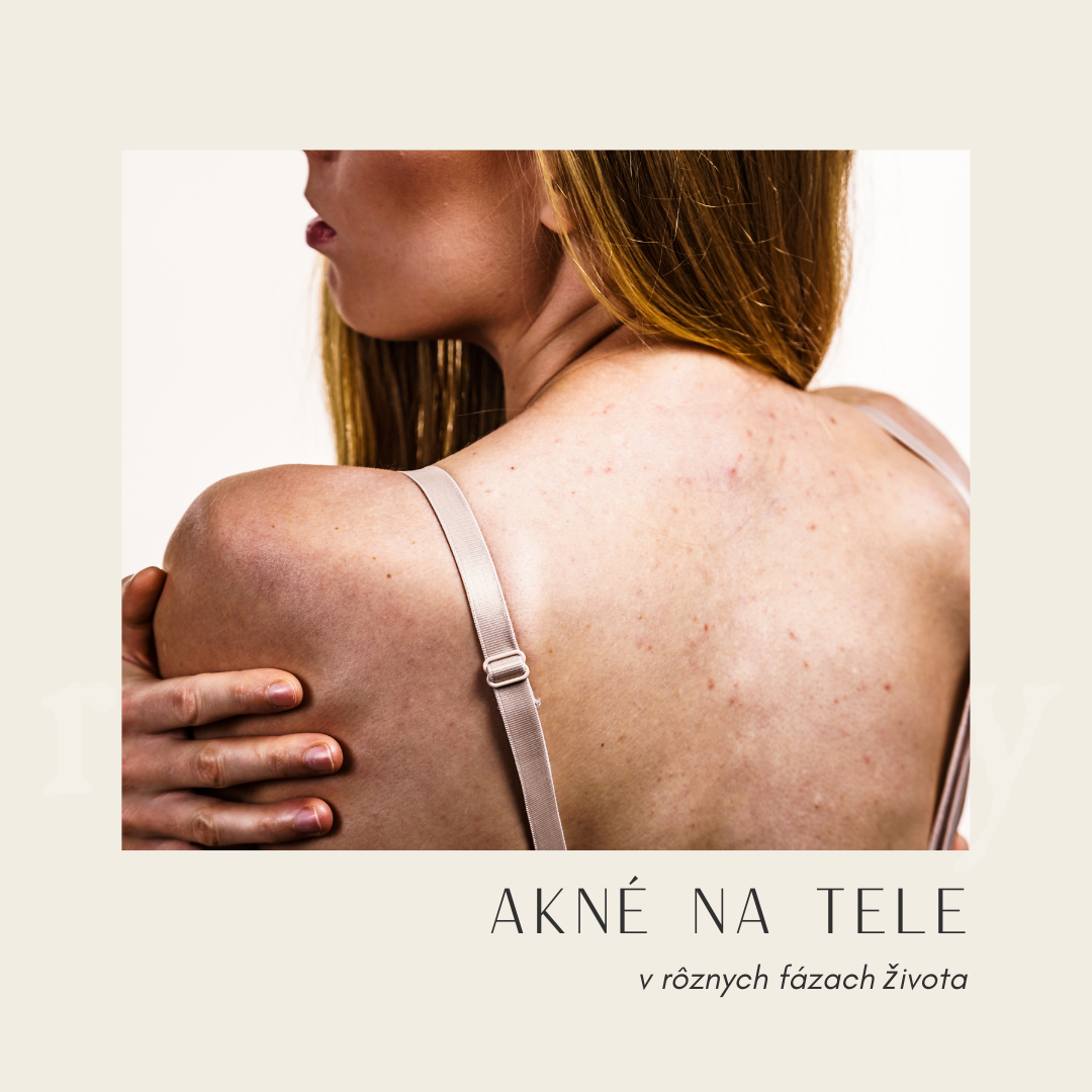 Akné na tele a v rôznych fázach života. Čo s tým?