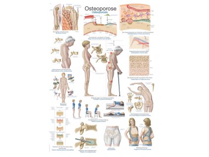 Plakát - osteoporóza 70x100 cm