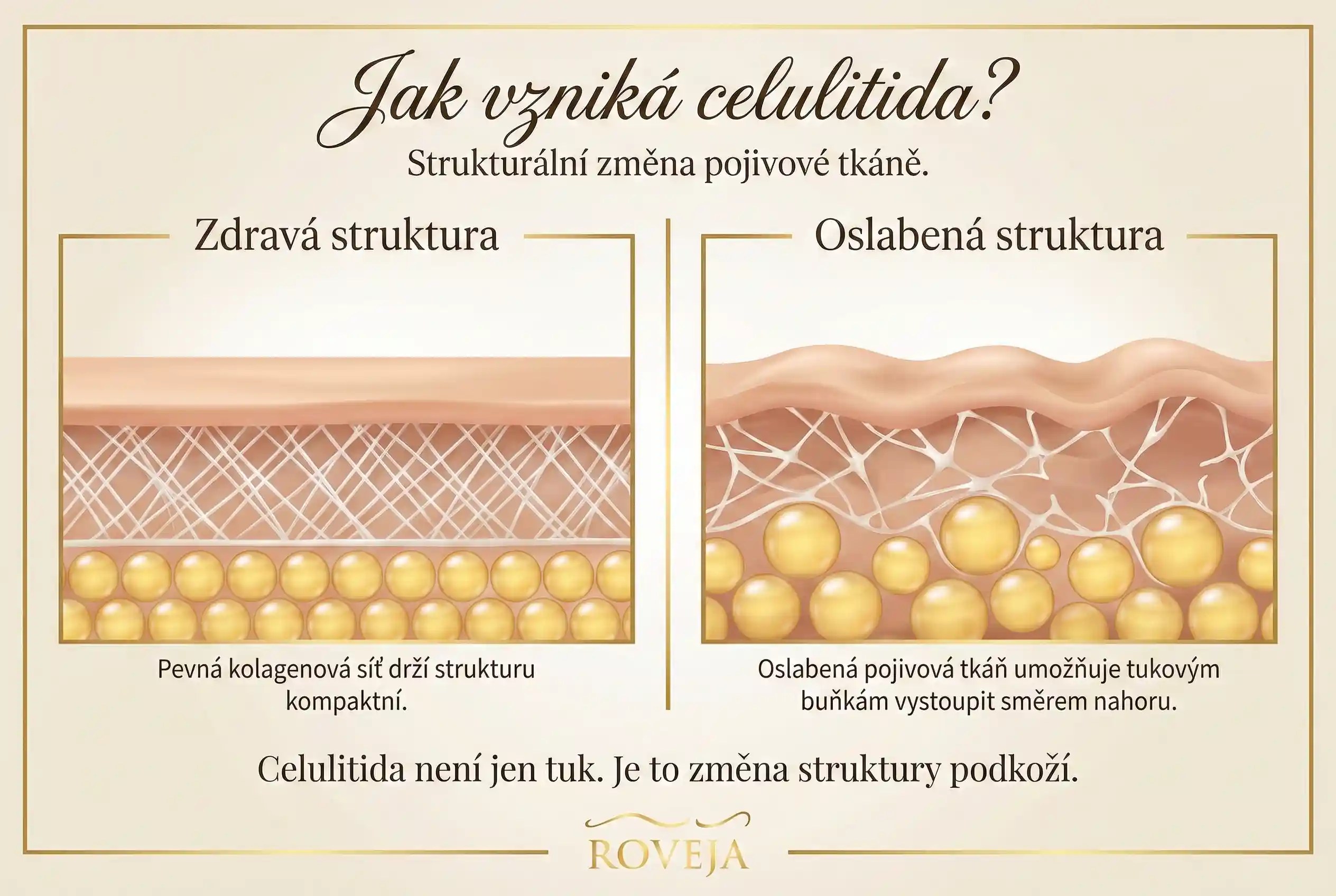 Jak vzniká celulitida – zdravá vs oslabená struktura podkoží
