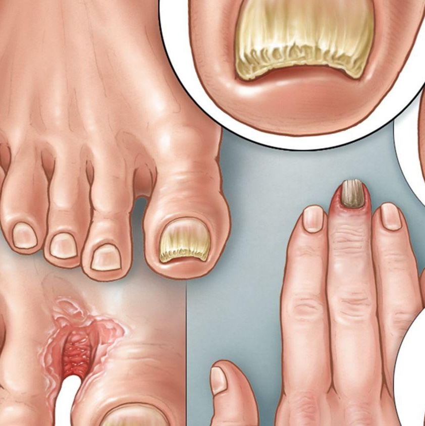 Nagelpilz. Wie kann man ihn erkennen und wie kann man ihm vorbeugen?