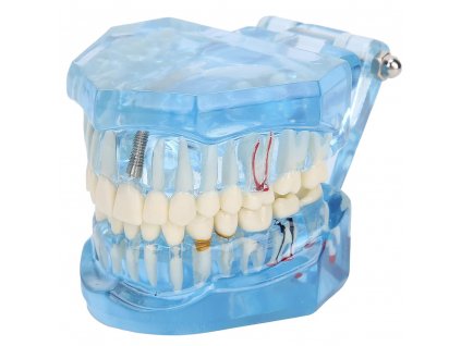 168110 verk 01964 n model zubnich implantatu modra