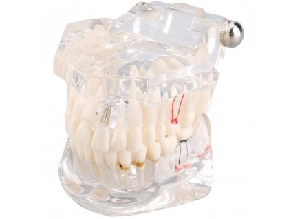 168056 verk 01964 b model zubnich implantatu bila