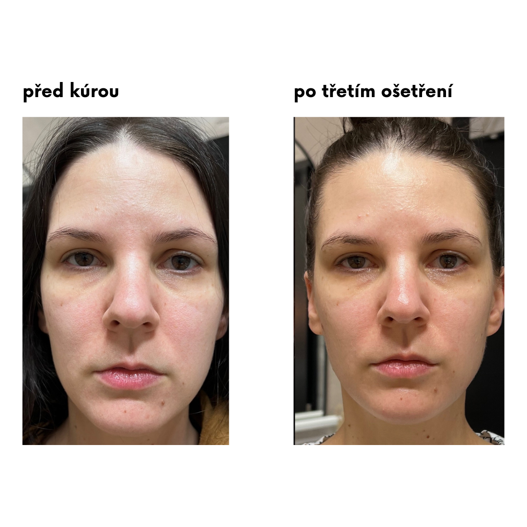 Manuální Lifting obličeje. Co od něj (ne) čekat?