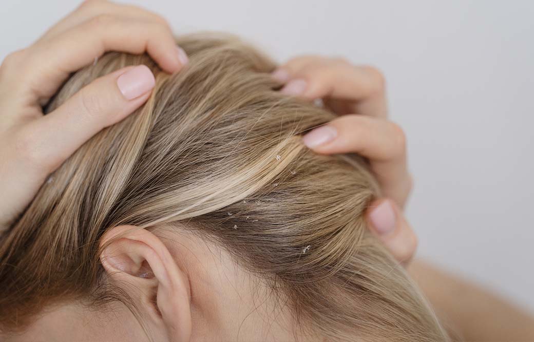 Lupénka ve vlasech: vše, co potřebujete vědět