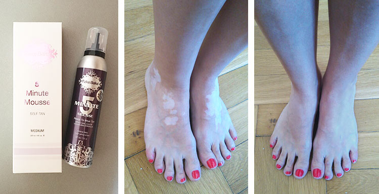 vitiligo-obrazky-clanok-fake-bake-5minute-mousse