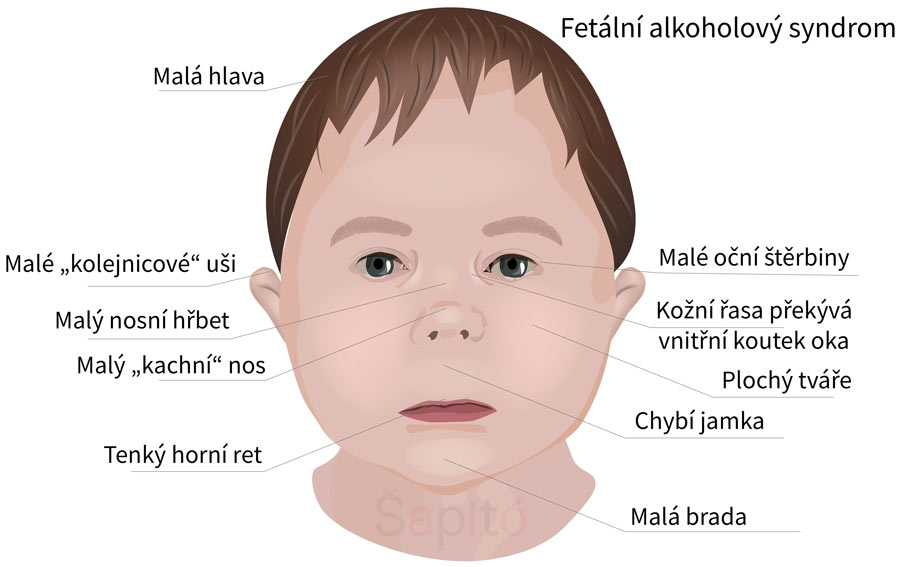 fetální alkoholový syndrom