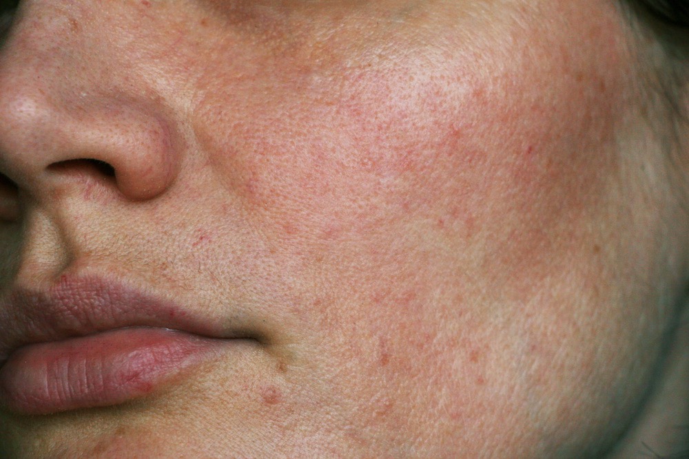 Rosacea (růžovka) a mikrobiom: Co způsobuje podráždění a jak ho zmírnit