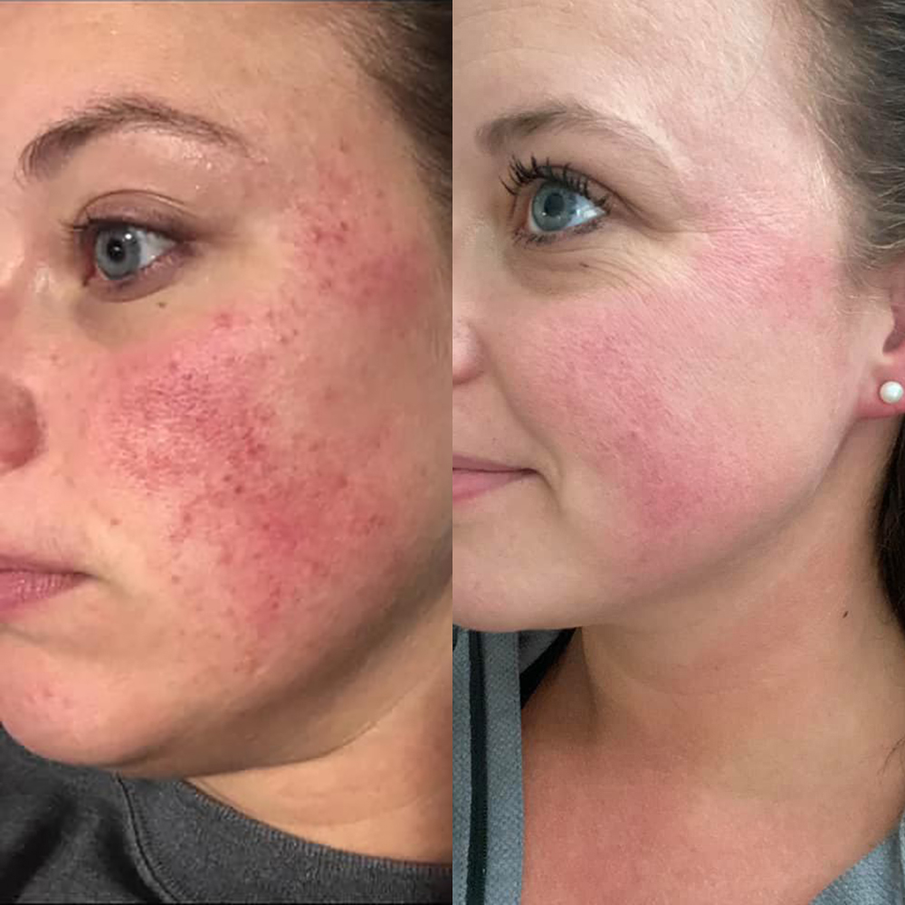 blissoma-rosacea-ruzovka