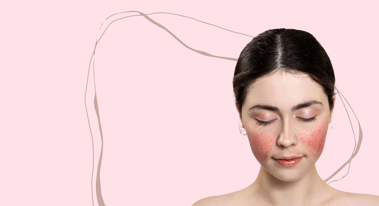 Rosacea a korejská kosmetika