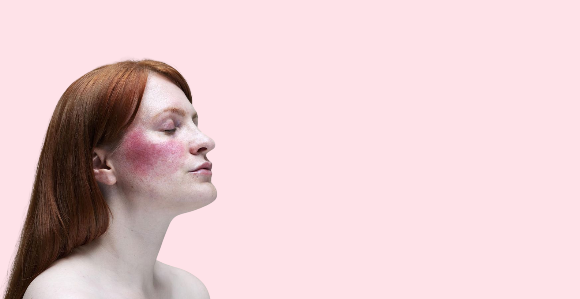 Rosacea