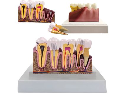 Anatomický stomatologický zubní model - vyjímatelný zub