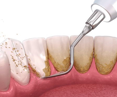 Efektivní způsoby, jak odstranit zubní kámen