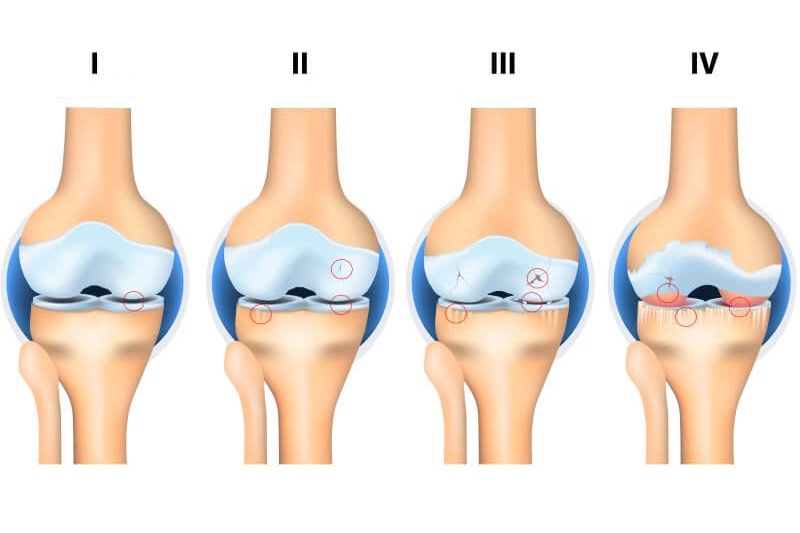 Dá sa poškodená chrupavka opraviť?
