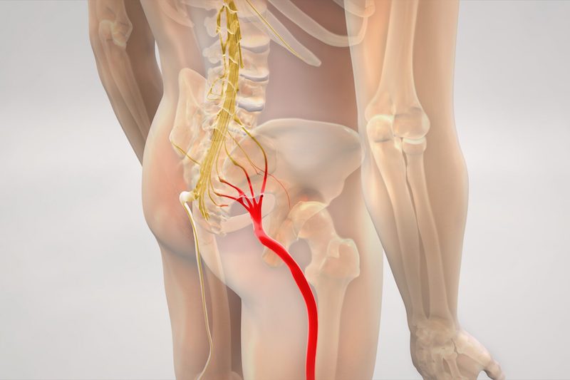 Pochopenie symptómov ischiasu: mravčenie, necitlivosť, mrznutie a pálenie