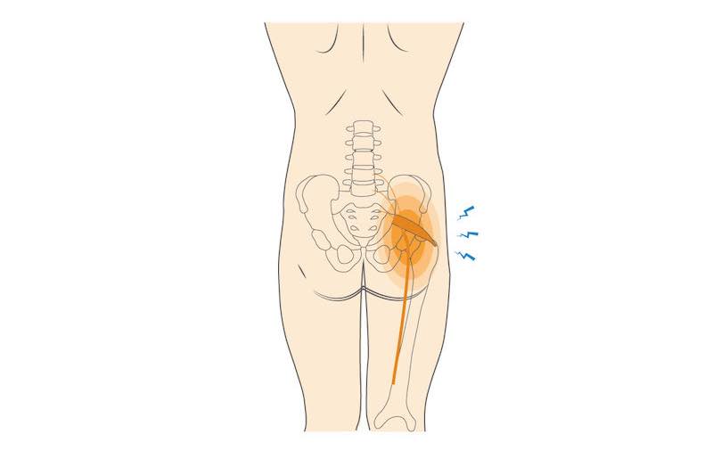Je syndróm piriformis to isté ako ischias?