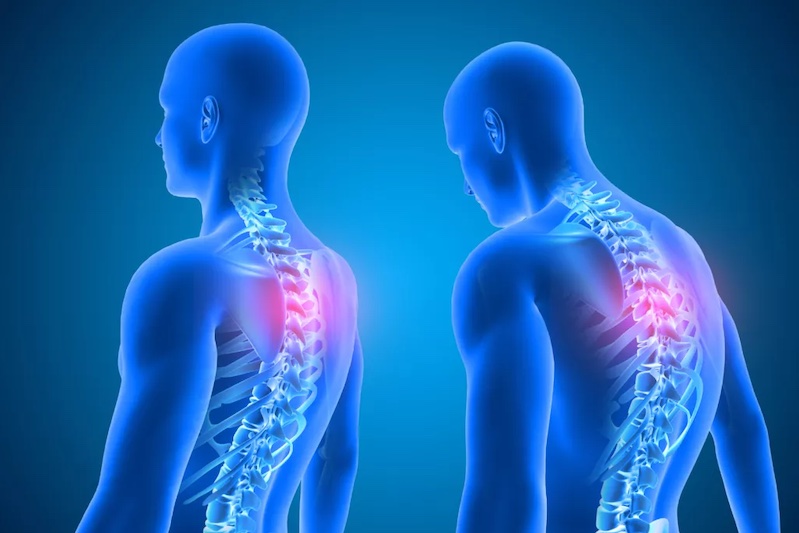 Aký je pocit pri kompresii miechy a nervov