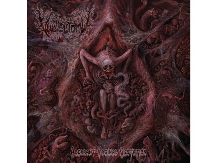 VULVECTOMY - ABERRANT VAGINAL GESTATION - CD