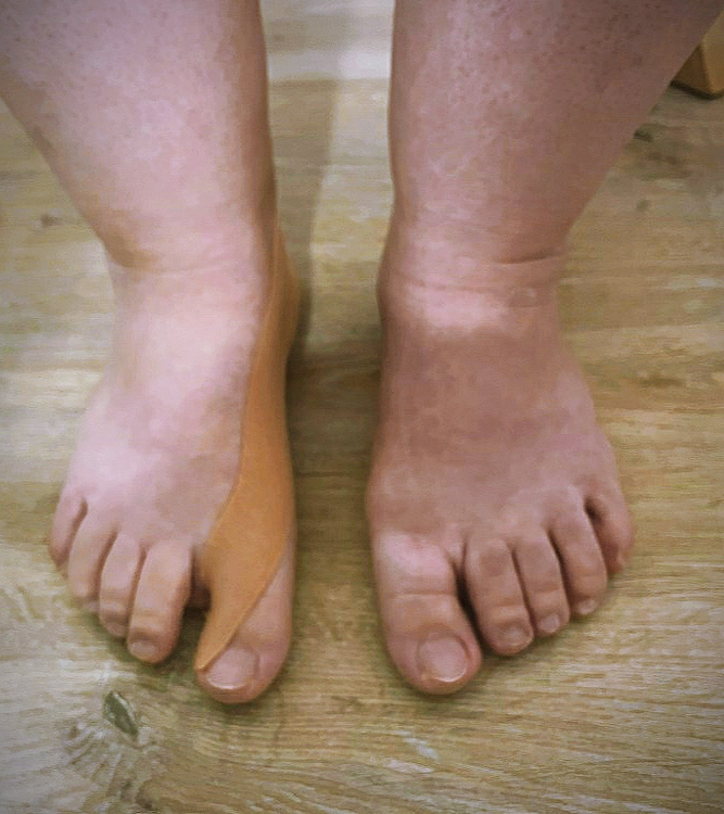 Hallux valgus - vbočený palec