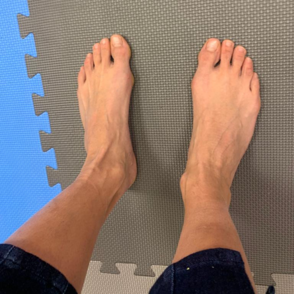 Jak si pomoci od vbočeného malíčku?