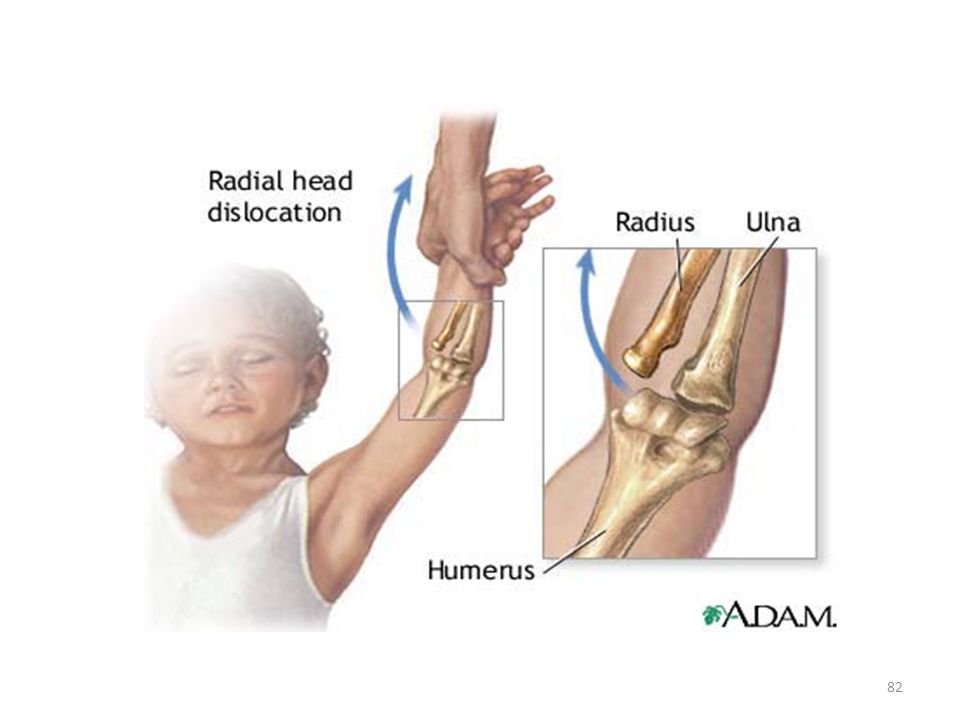 Pronatio dolorosa - pozor na špatné držení dětí