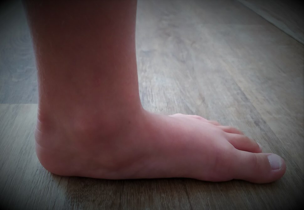 Hyperpronační syndrom