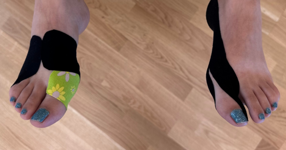 Jak zastavit progresi vbočeného palce bez operace