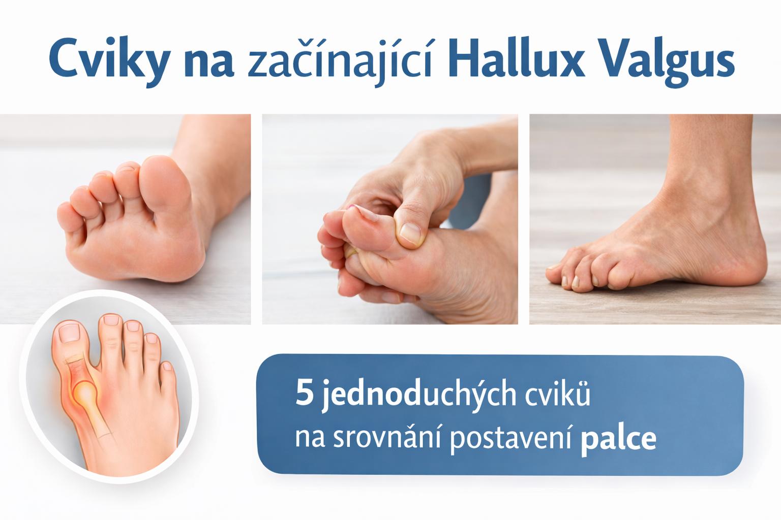 5 cviků na začínající hallux valgus