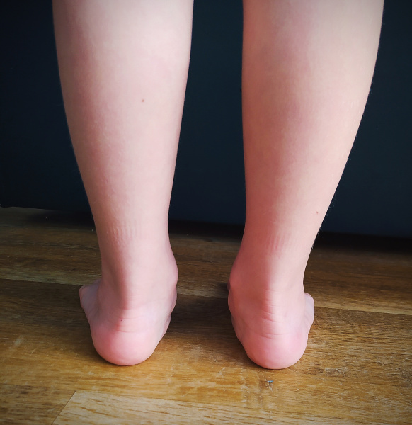 obr. 3 valgózní kotníky