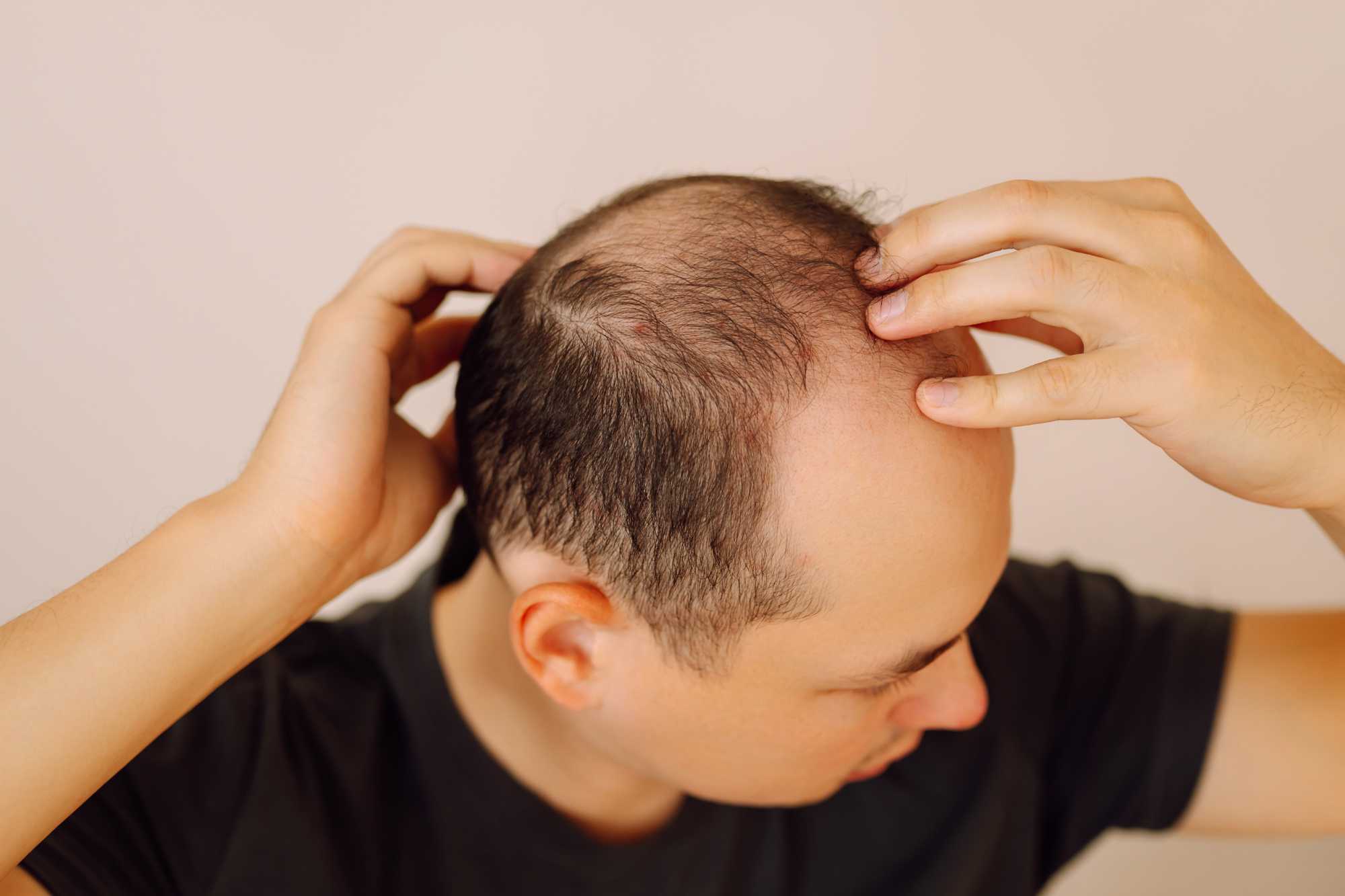 Čo skutočne pomáha proti vypadávaniu vlasov? Riešenia pre ženy aj mužov