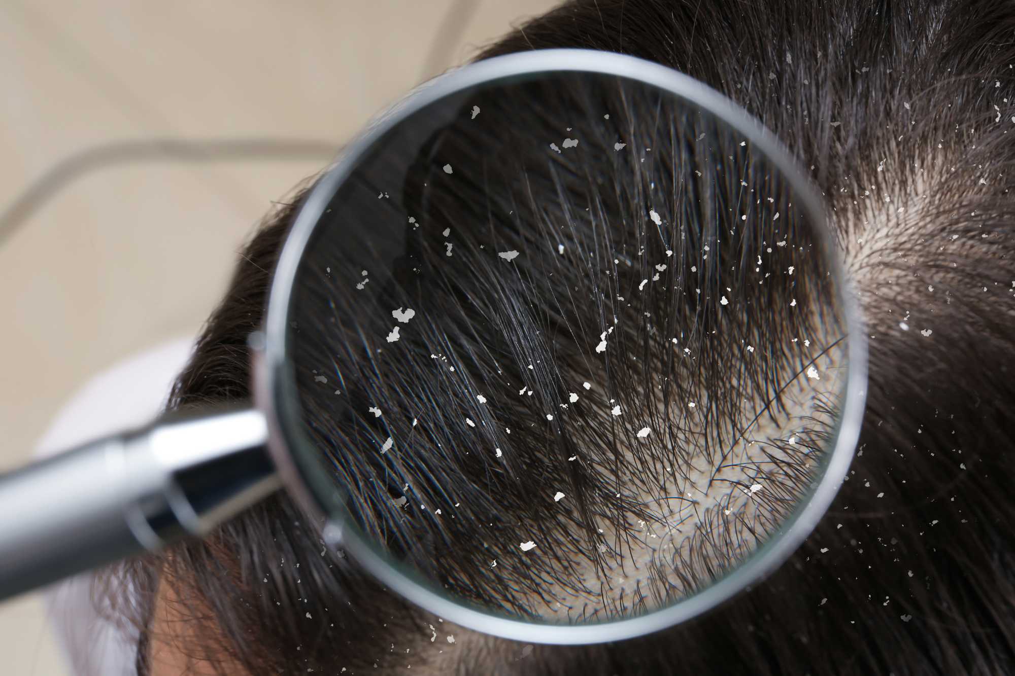 Ako vybrať najlepší šampón proti lupinám?