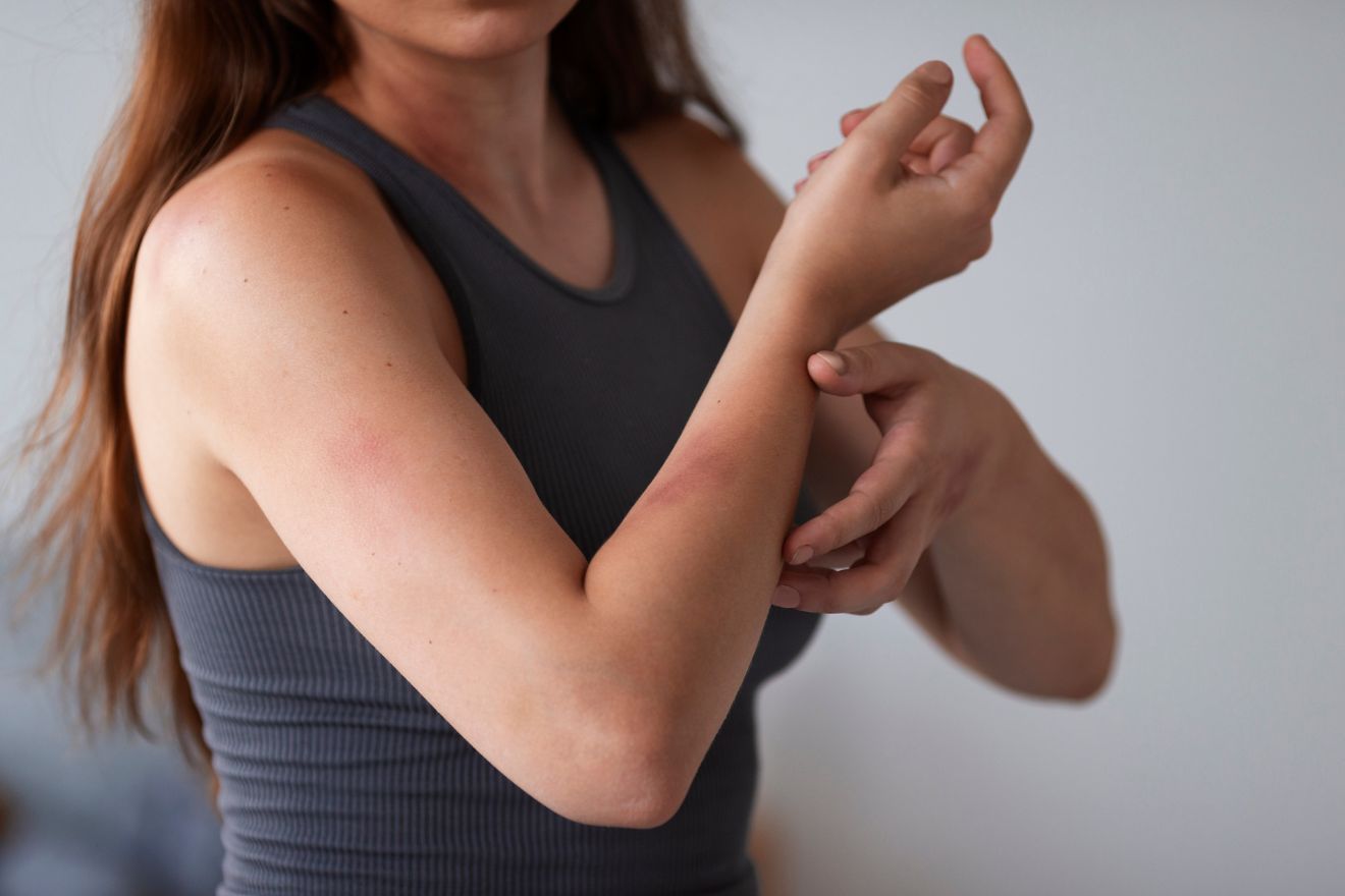 Alergia na samoopaľovanie: príznaky, prevencia a riešenia