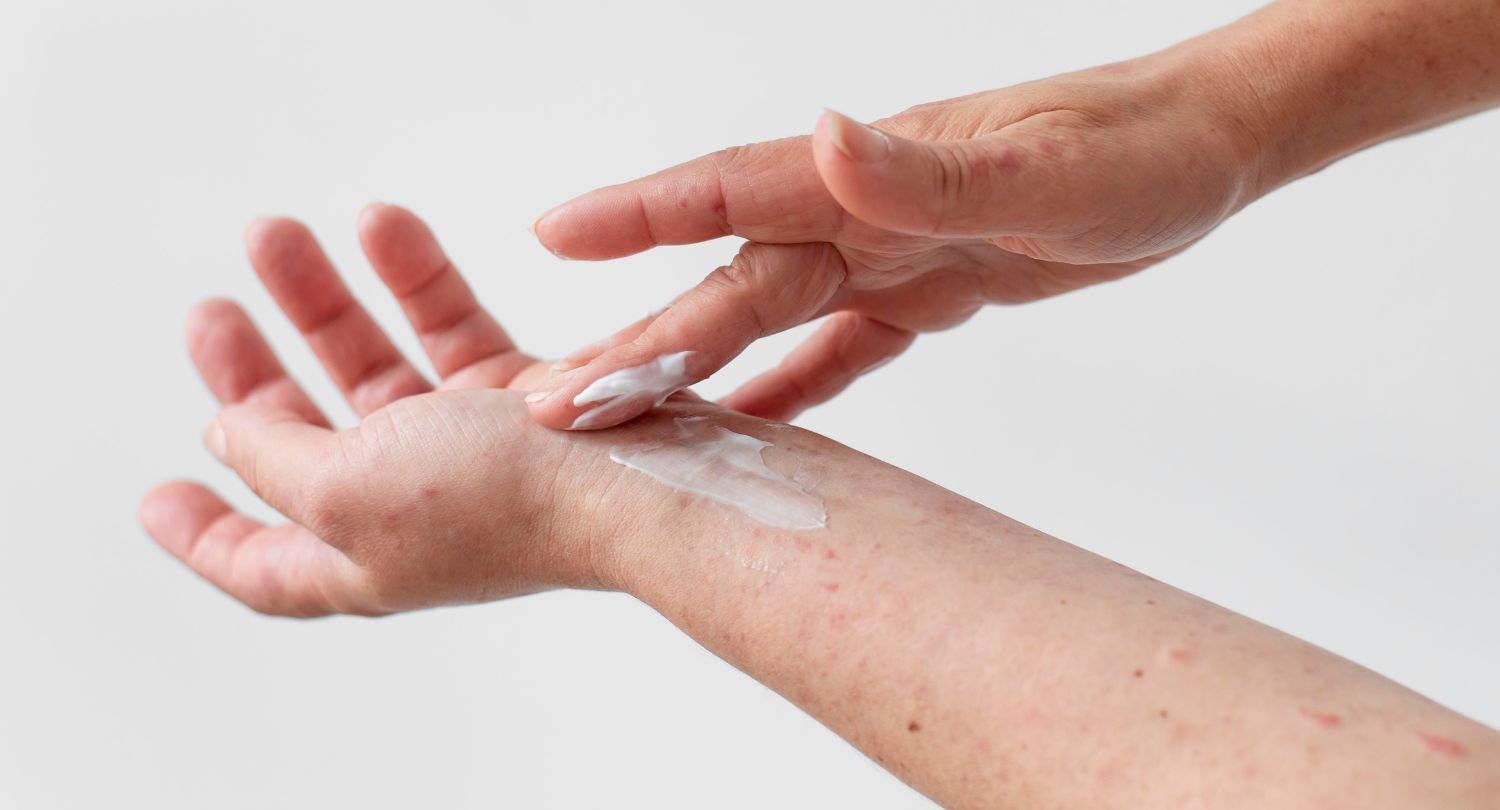 alergia_patch_test_sunsan