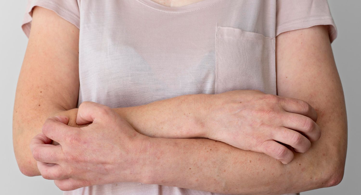 alergia_ruky_skrabanie