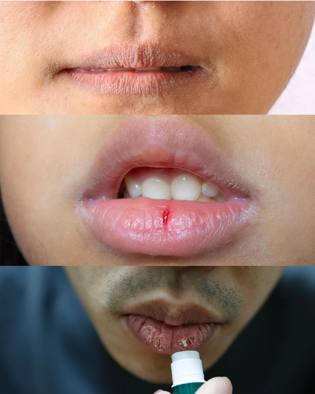 Prvá pomoc na suché pery v zime