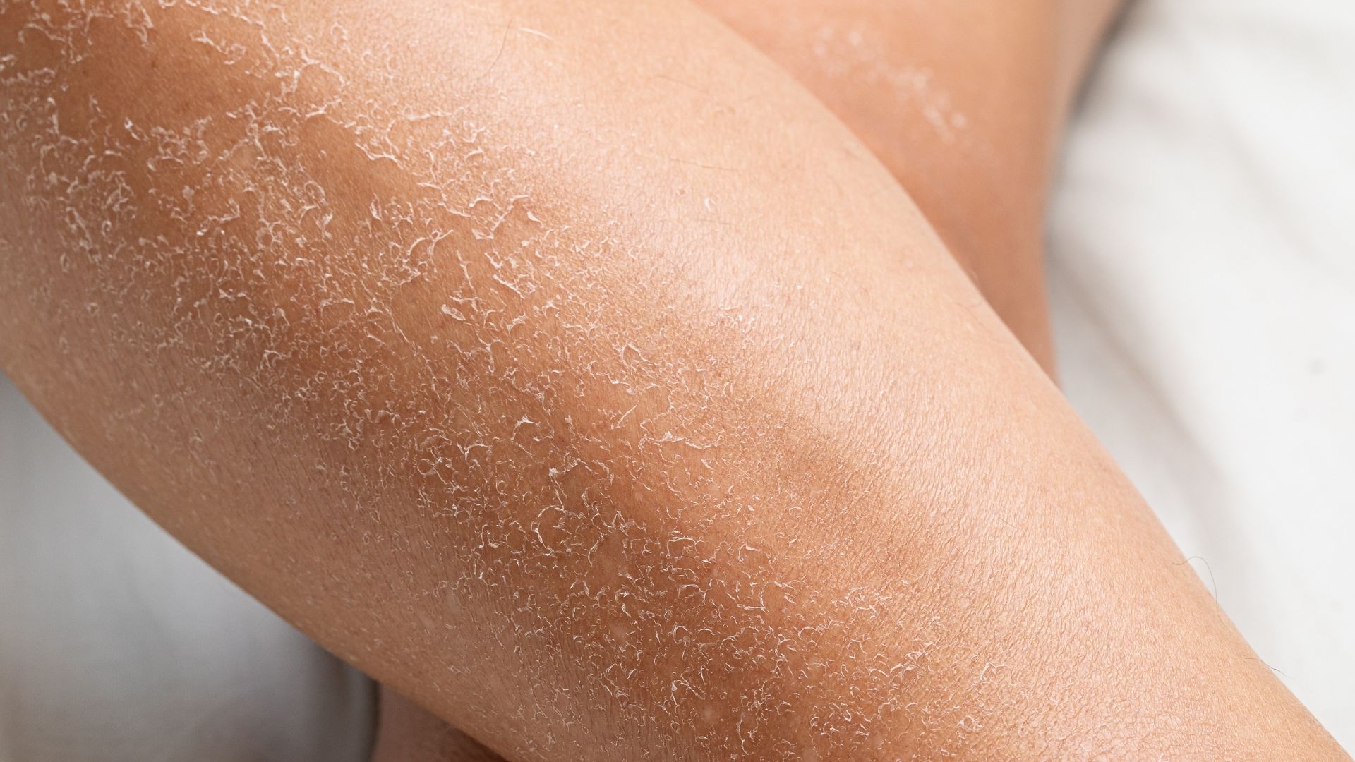 Ako bojovať so suchou pleťou počas zimy?