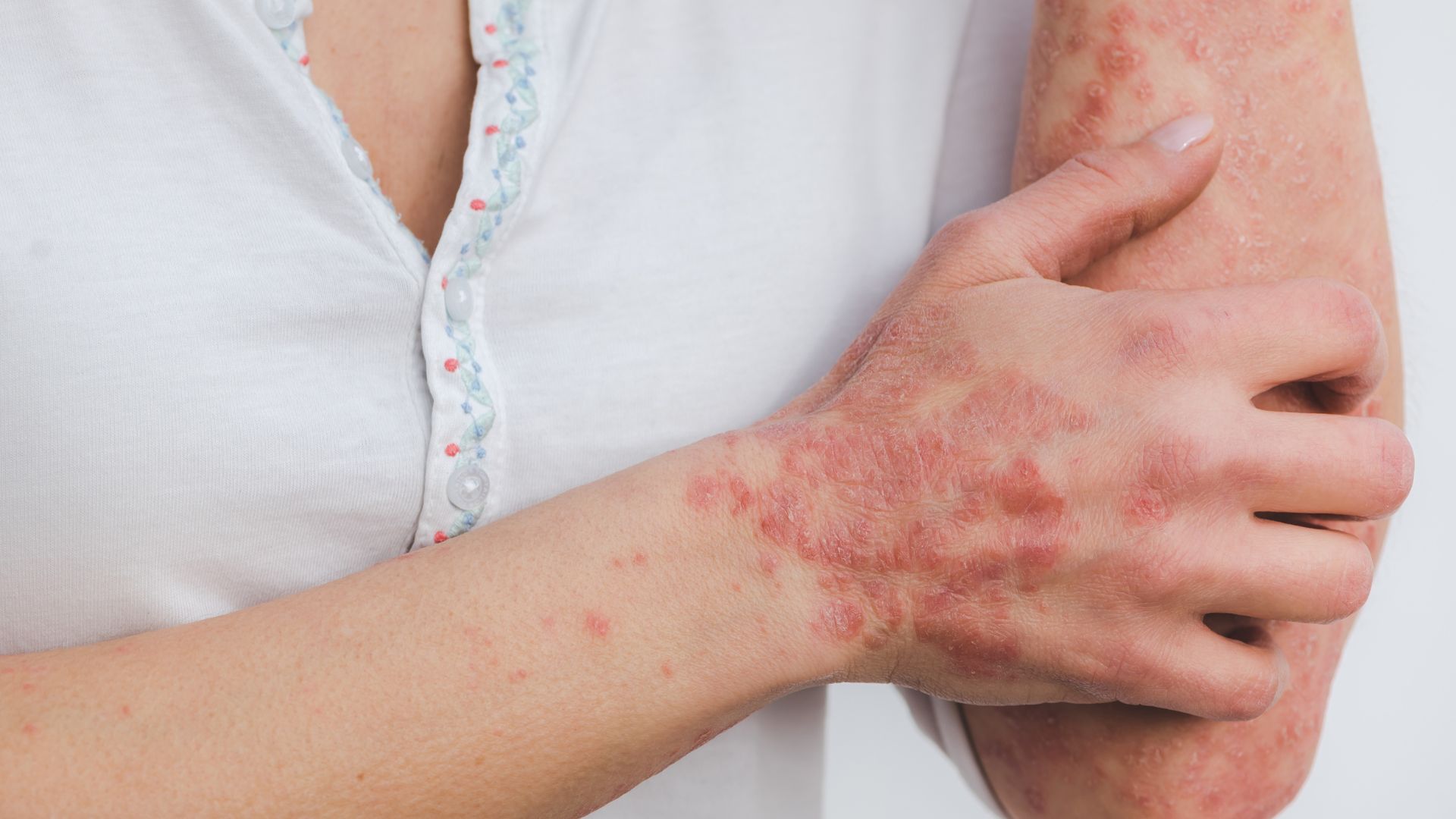 Psoriatrická artritída: Príčiny vzniku, príznaky a možnosti liečby