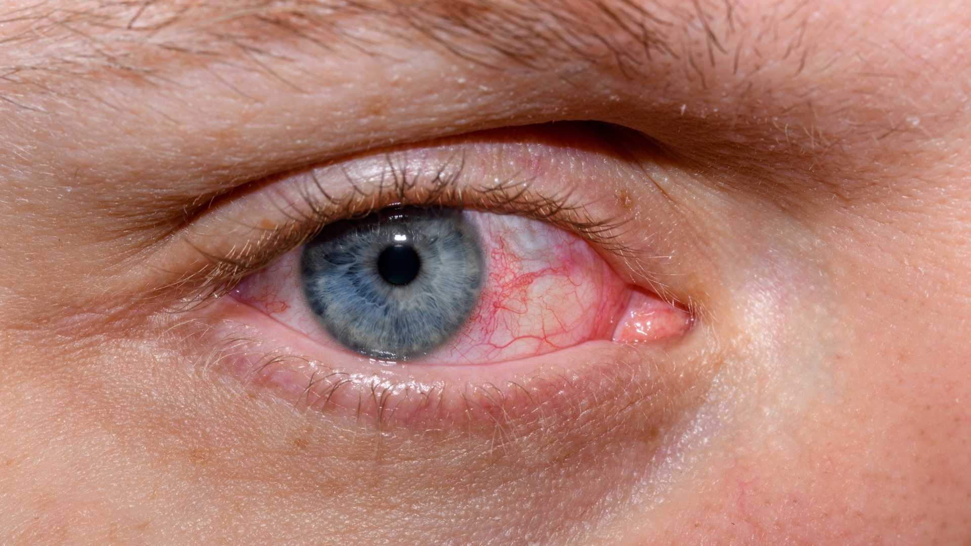 Syndróm suchého oka proč vzniká a co může pomoci