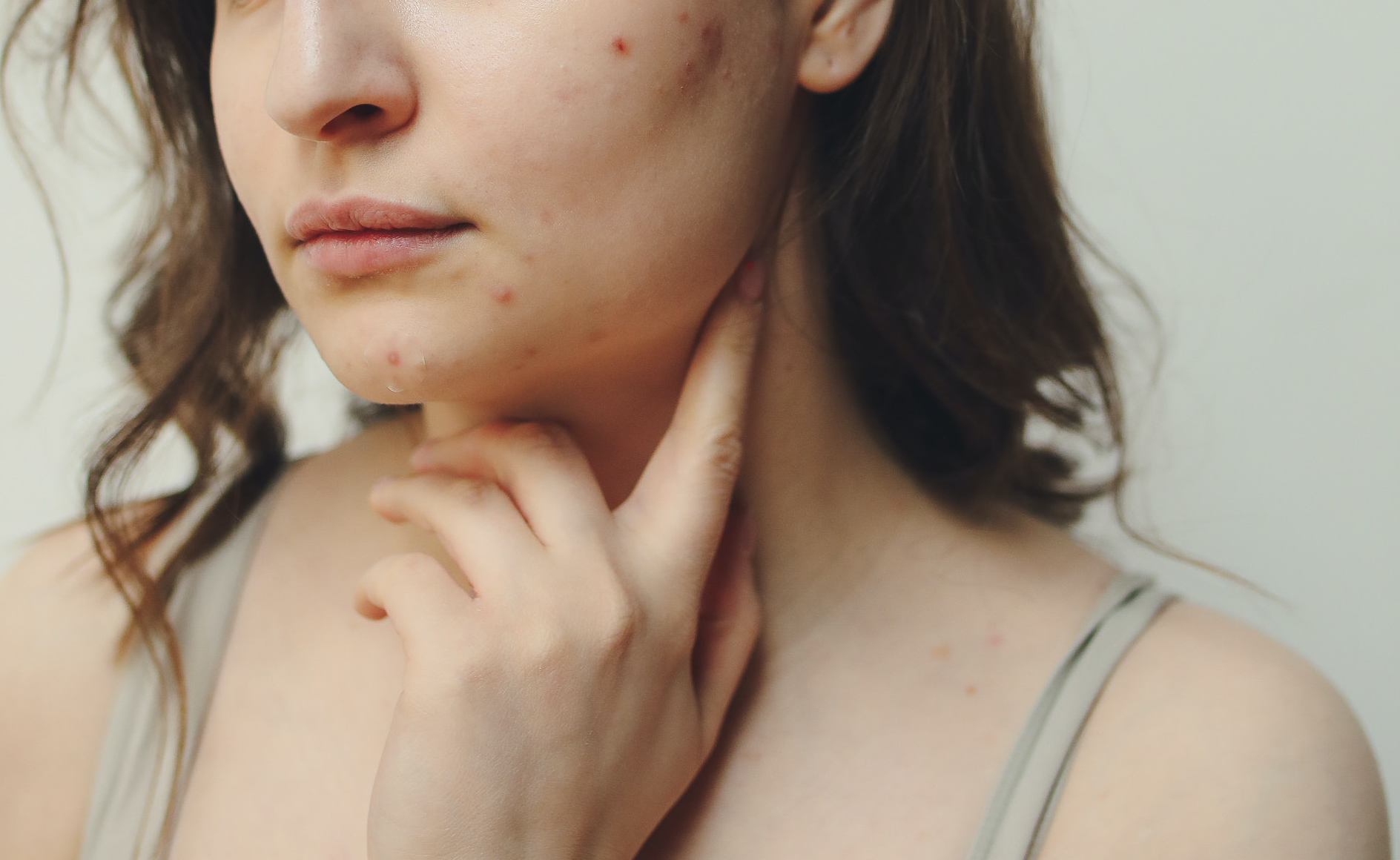 Essential tips on how to take care of acne-prone skin