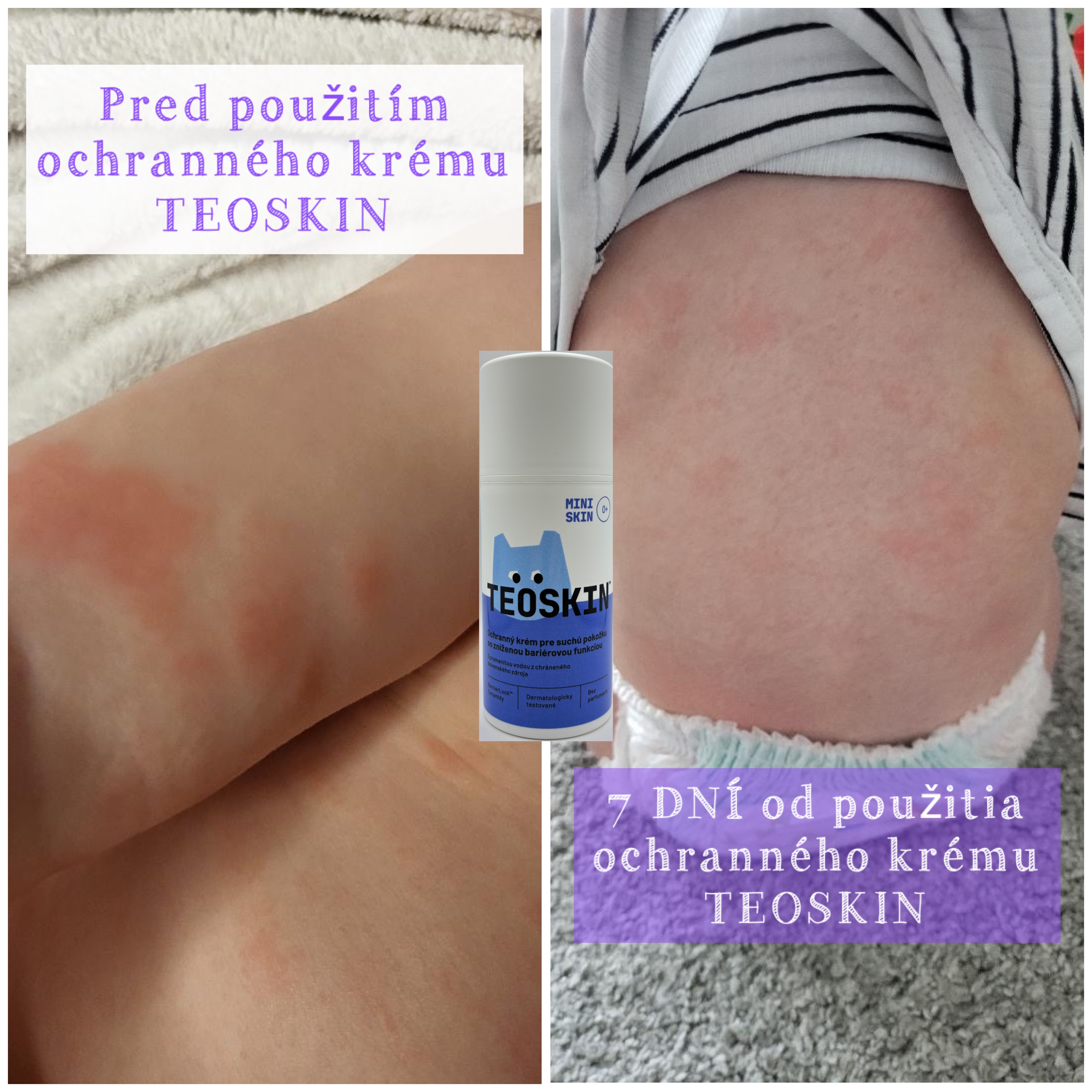 Výsledky pred a po Jana G. (10-mesačné bábätko) - Ochranný krém TEOSKIN