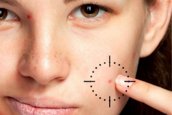 Jak se zbavit akné?