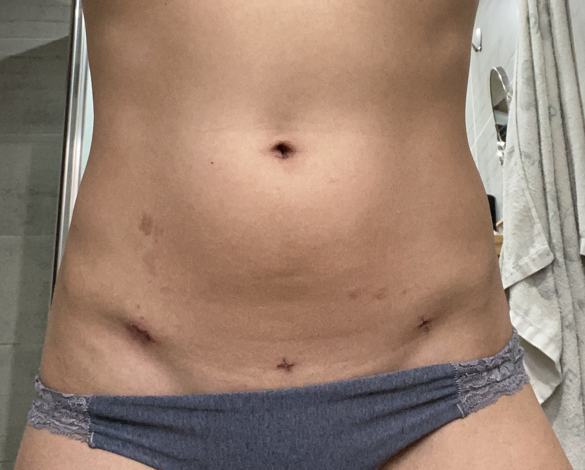 Endometrióza - konec nebo nový začátek?