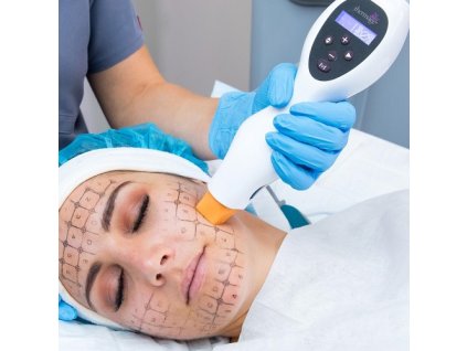 16 Thermage ošetření vybrané obličejové partie